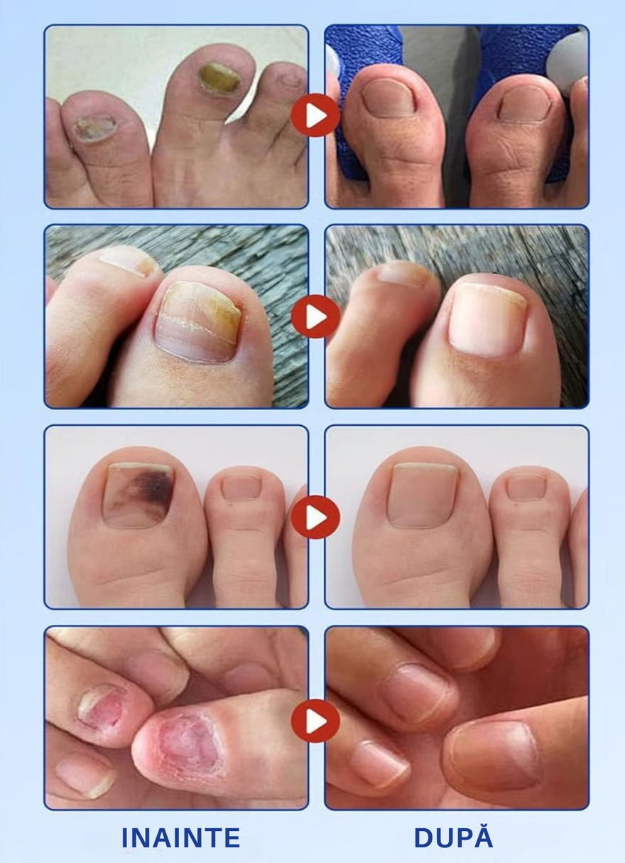 Plasturi Antifungici